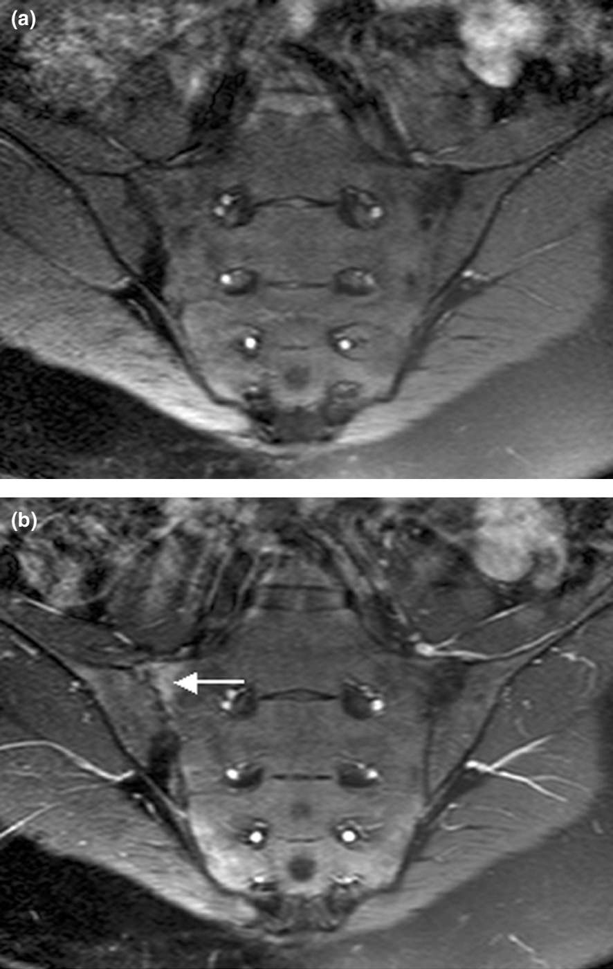 Active sacroiliitis. Semi-coronal T1 MRI of the sacroiliac joints, before (a) and after (b) contrast, with enhancement at the inflamed joint (arrow). McQueen et al., Arthritis Res Ther 2006;8:207, CC BY 2.0.