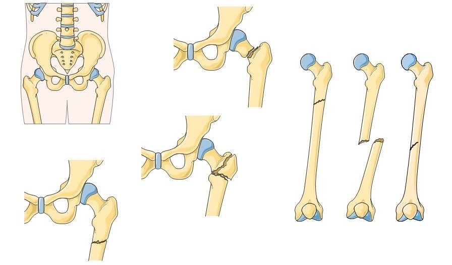 Figure 1. Common fracture locations of the femur, including the supracondylar (distal) region. Illustration by Servier Medical Art, CC BY-SA 3.0, via Wikimedia Commons.