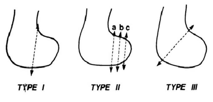 Figure 3. Letenneur classification of the Hoffa fracture (coronal-plane posterior femoral condyle), Types I-III. Image by Kapoor et al., CC BY-SA 1.0, via Wikimedia Commons.