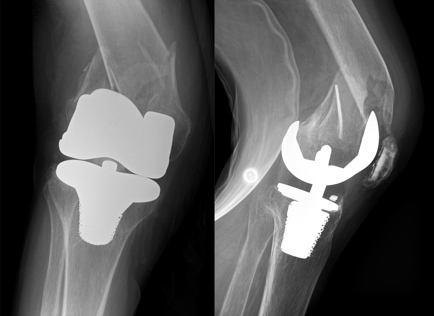 Figure 5. Periprosthetic distal femur fracture immediately above a total knee arthroplasty (AP and lateral radiographs). Image by Hellerhoff, CC BY-SA 4.0, via Wikimedia Commons.