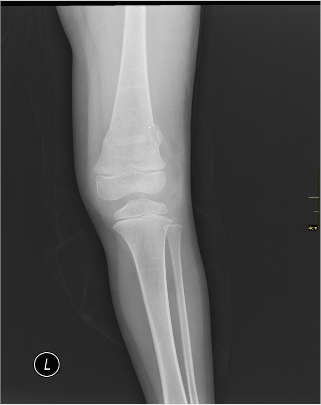 Figure 7. Distal femoral fracture in a skeletally immature patient with open physes, AP radiograph. Image by Nevit Dilmen, CC BY-SA 3.0, via Wikimedia Commons.