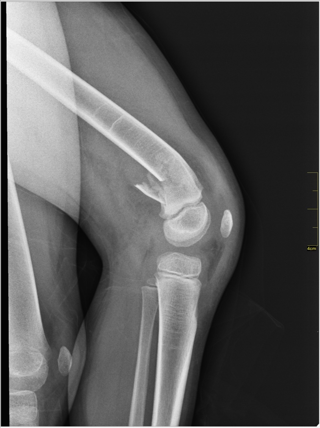 Figure 8. The same paediatric distal femoral fracture on the lateral radiograph, the distal fragment displaced posteriorly. Image by Nevit Dilmen, CC BY-SA 3.0, via Wikimedia Commons.
