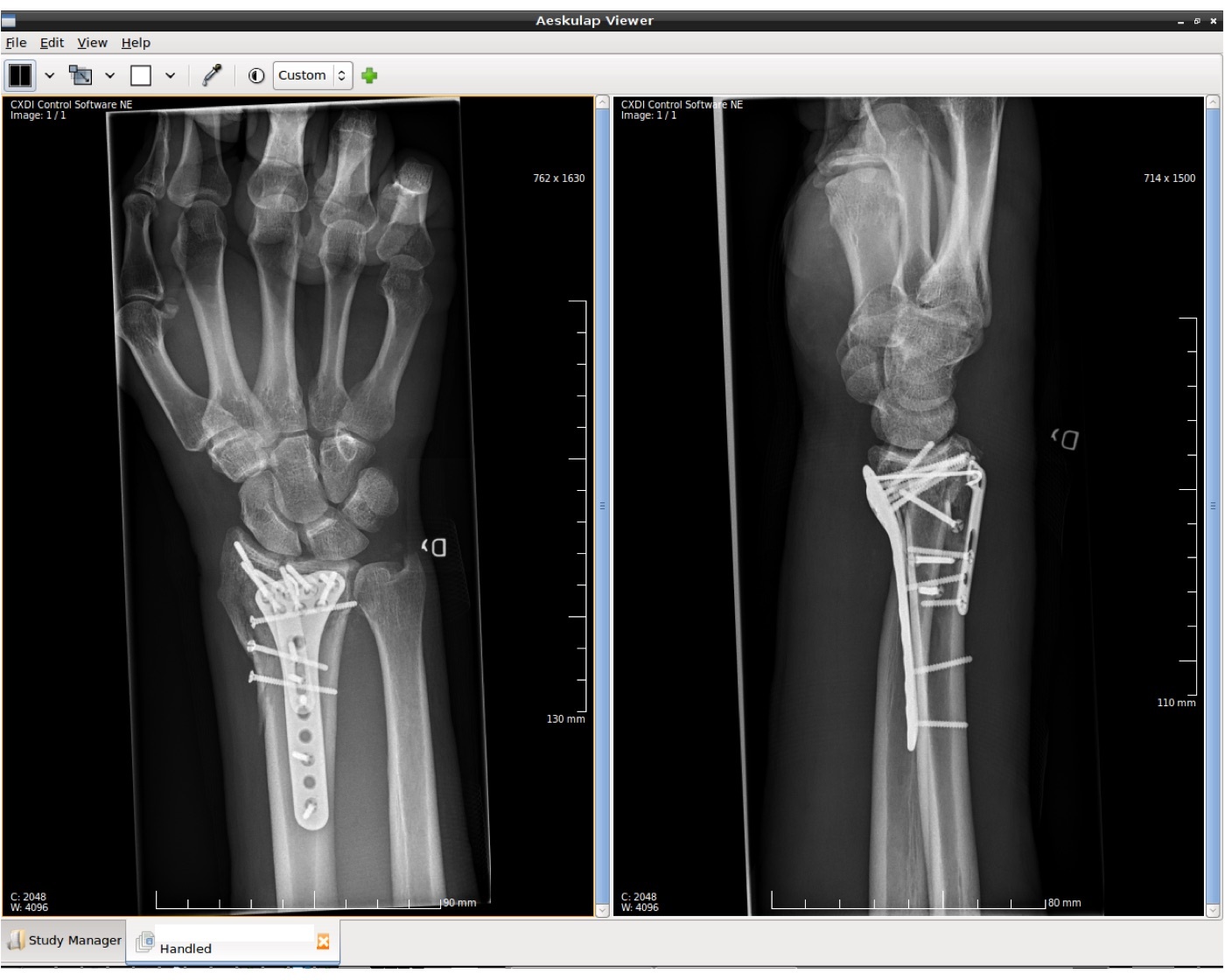 Figure 12. A distal radius fracture after volar plate-and-screw fixation, the workhorse construct (AP and lateral radiographs). DavidIvar, via Wikimedia Commons, CC BY-SA 4.0.