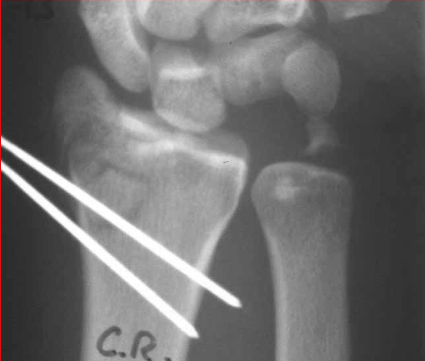 Figure 15. Percutaneous Kirschner wires across a reduced distal radius fracture. Curtishand, via Wikimedia Commons (public domain).