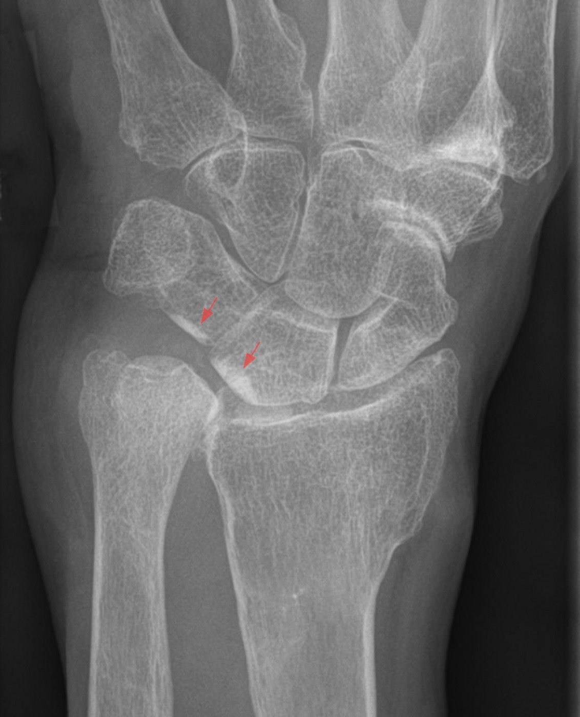 Figure 16. Ulnocarpal impaction after a shortened distal radius malunion (positive ulnar variance; AP view). Hellerhoff, via Wikimedia Commons, CC BY-SA 3.0.