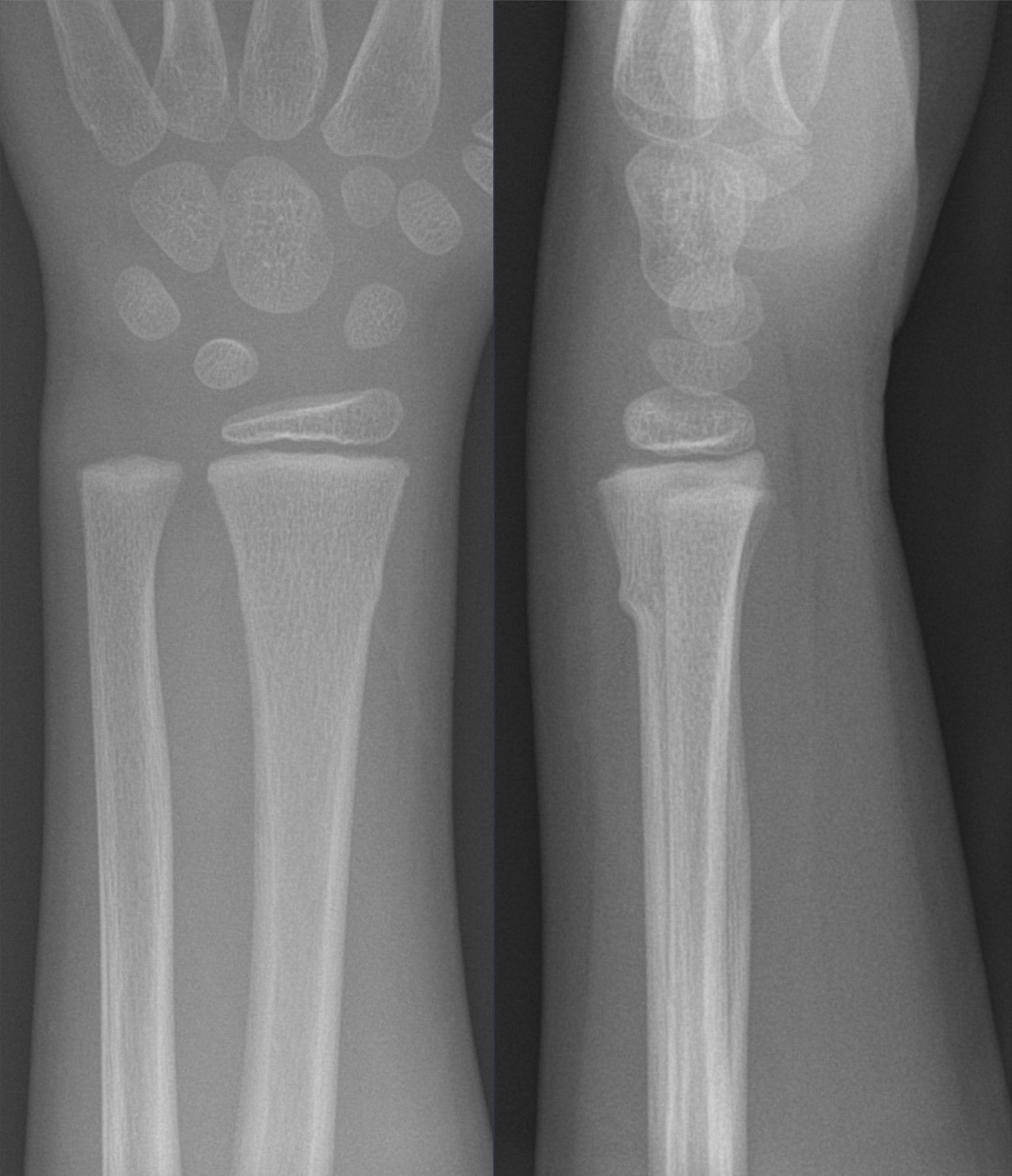 Figure 1. A torus (buckle) fracture of the distal radius in a child, AP and lateral views; the distal radius is the commonest fracture site in children. Hellerhoff, via Wikimedia Commons, CC BY-SA 4.0.