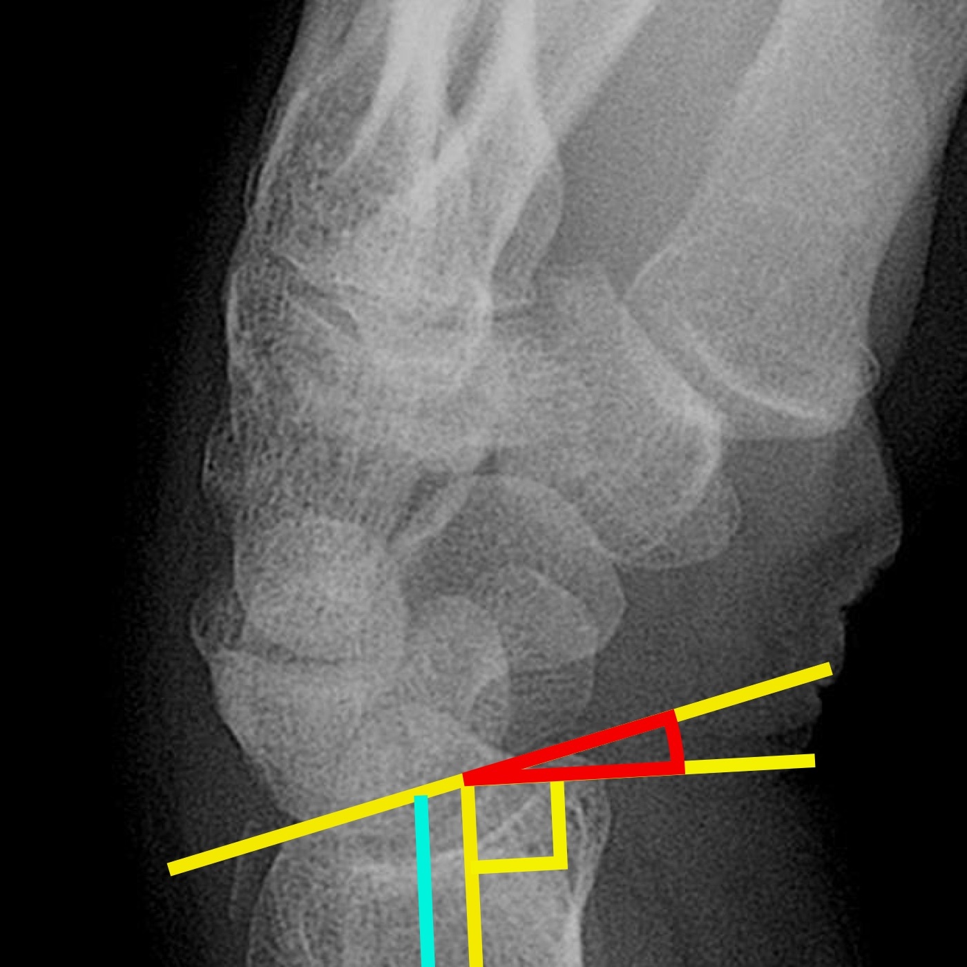 Figure 2. Volar/dorsal tilt of the distal radius on an annotated lateral radiograph. Mikael Häggström, from a base image by Lucien Monfils, via Wikimedia Commons, CC BY-SA 3.0.