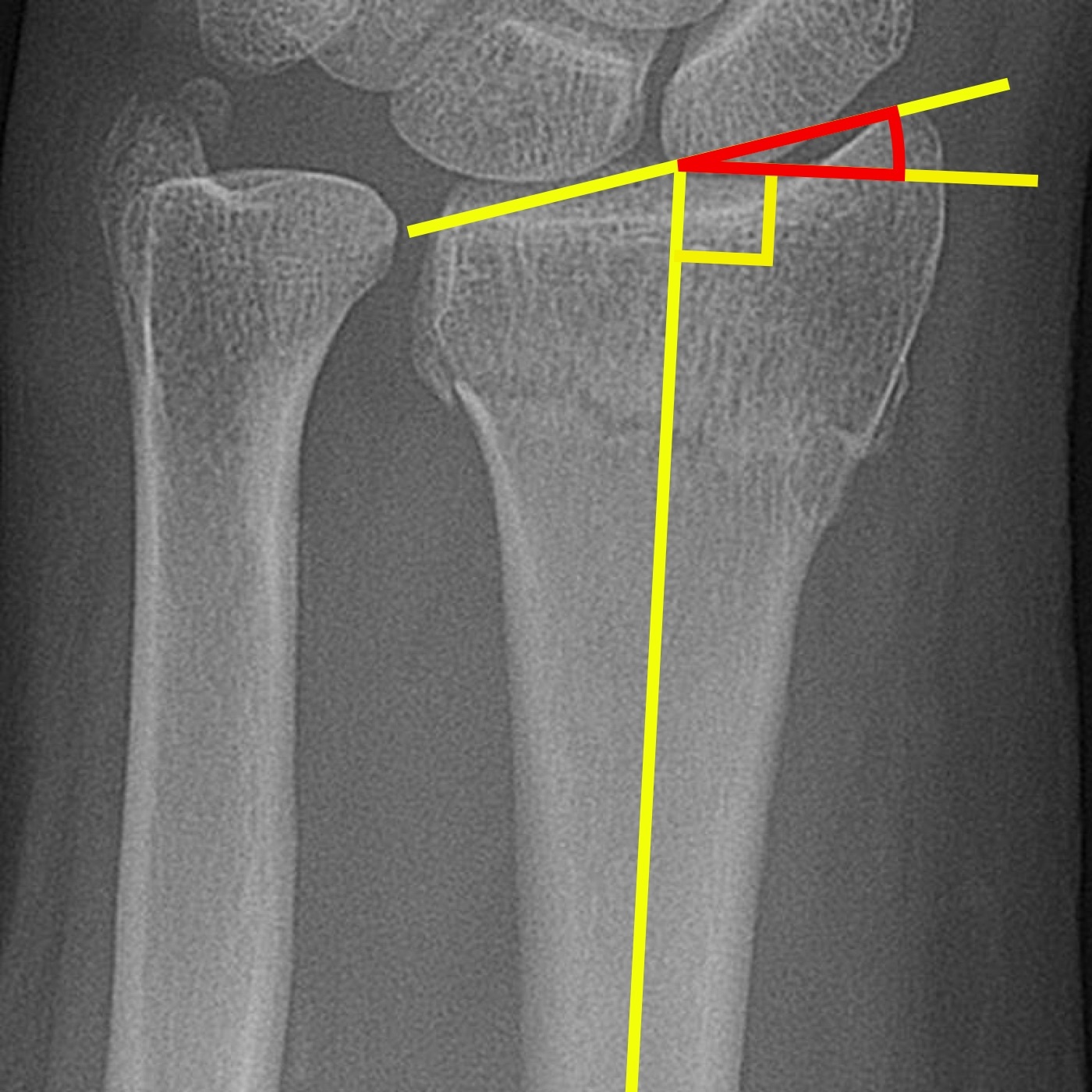 Figure 3. Radial inclination of the distal radius on an annotated AP radiograph. Mikael Häggström, from a base image by Lucien Monfils, via Wikimedia Commons, CC BY-SA 3.0.