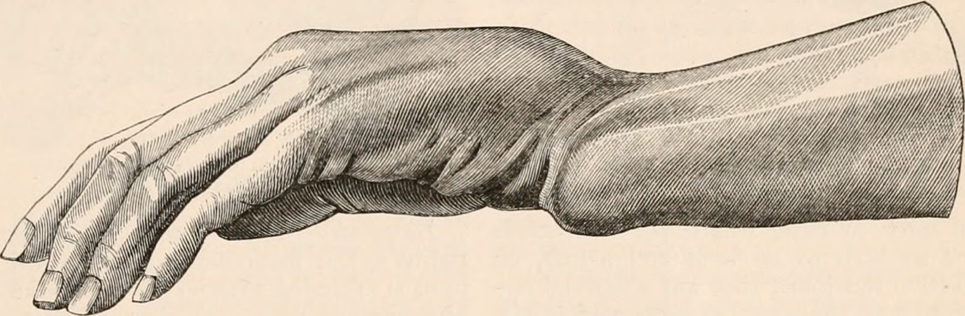 Figure 5. The dinner-fork (silver-fork) deformity of a dorsally displaced distal radius fracture. Engraving from Todd, Cyclopædia of Anatomy and Physiology (1849), public domain.