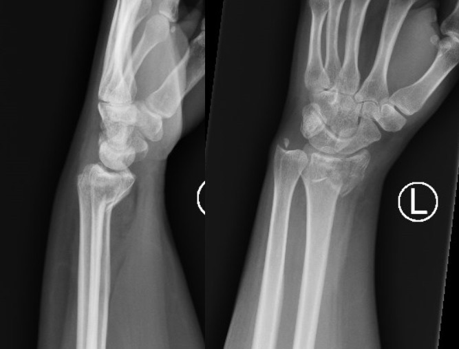 Figure 6. Smith fracture of the distal radius with volar displacement (AP and lateral views), the reverse of a Colles fracture. James Heilman, MD, via Wikimedia Commons, CC BY-SA 4.0.