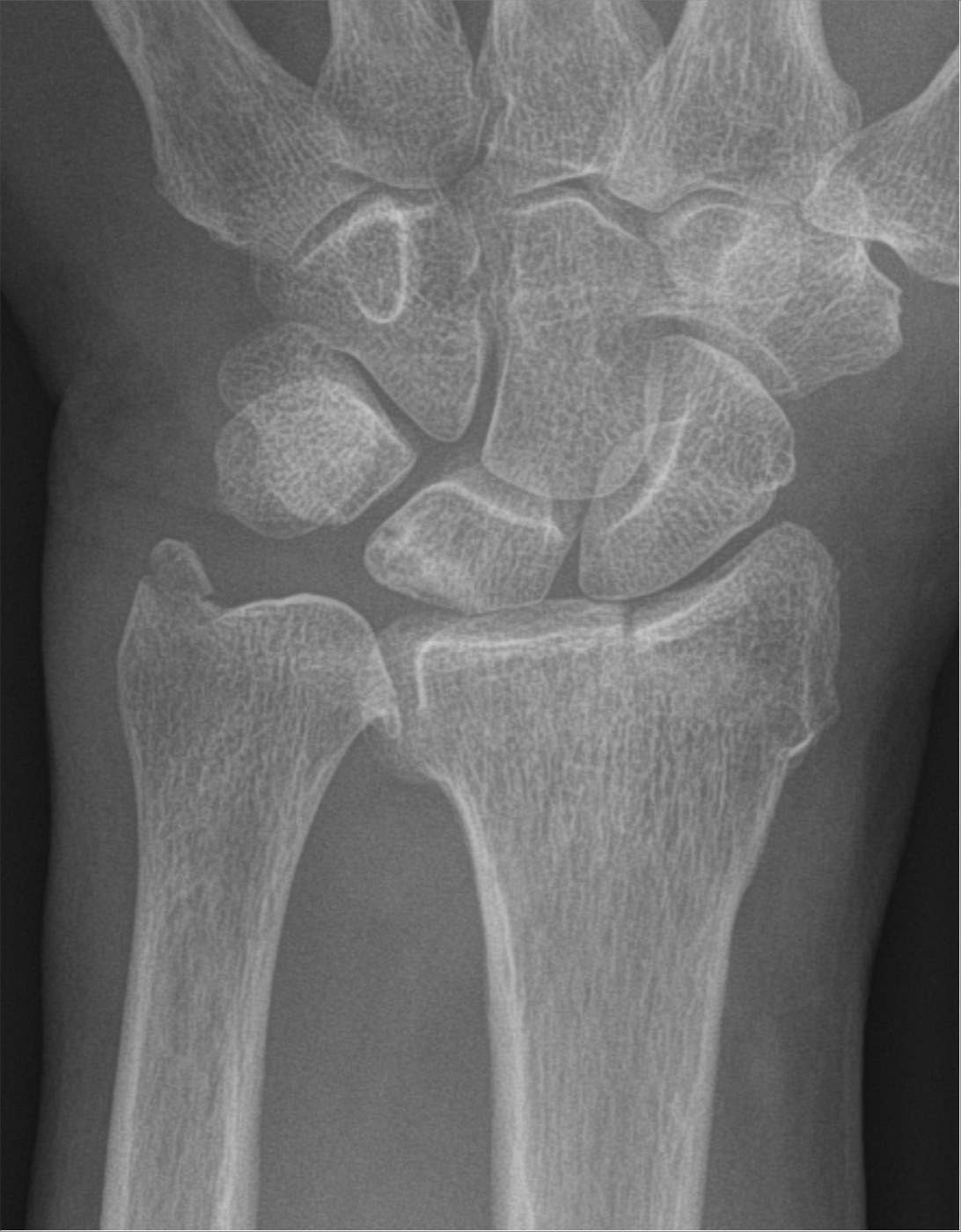 Figure 8. Chauffeur (radial styloid) fracture of the distal radius (AP view). Hellerhoff, via Wikimedia Commons, CC BY-SA 4.0.