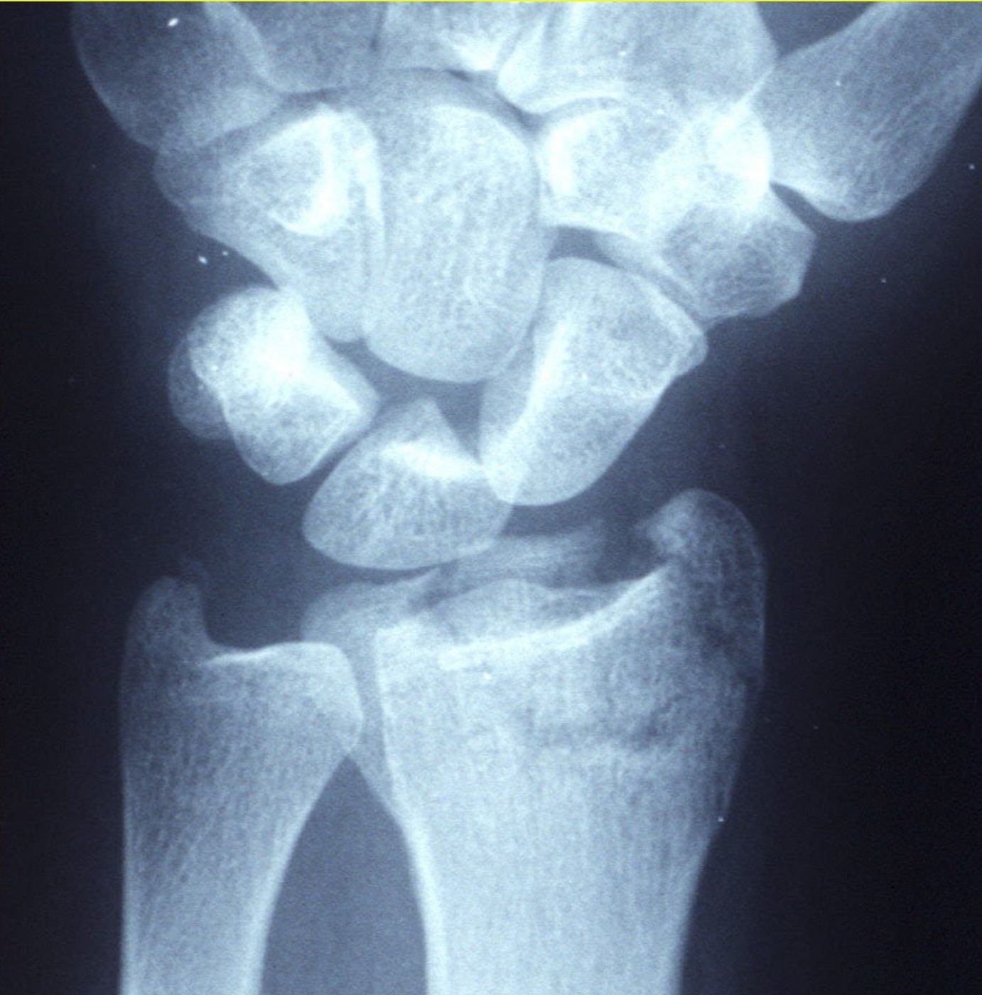 Figure 9. A displaced intra-articular (AO type C) distal radius fracture. Curtishand, via Wikimedia Commons (public domain).