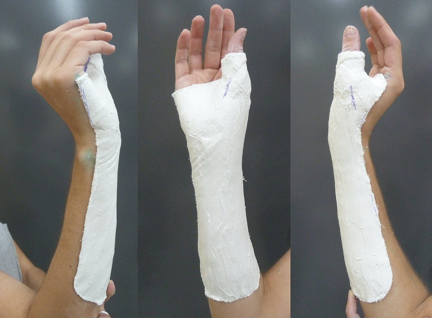 Figure 11. A plaster forearm cast immobilising the wrist after closed treatment of a distal radius fracture. Jackson P\&O, via Wikimedia Commons, CC BY-SA 3.0.