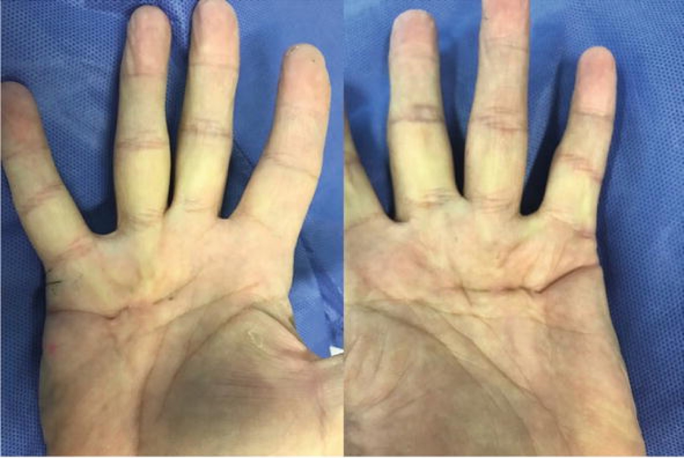 Figure 1. Dupuytren disease: palmar cords producing flexion contractures of the ring and little fingers. From Johnson, Pavano & Rodner (2018), IntechOpen, CC BY 3.0.