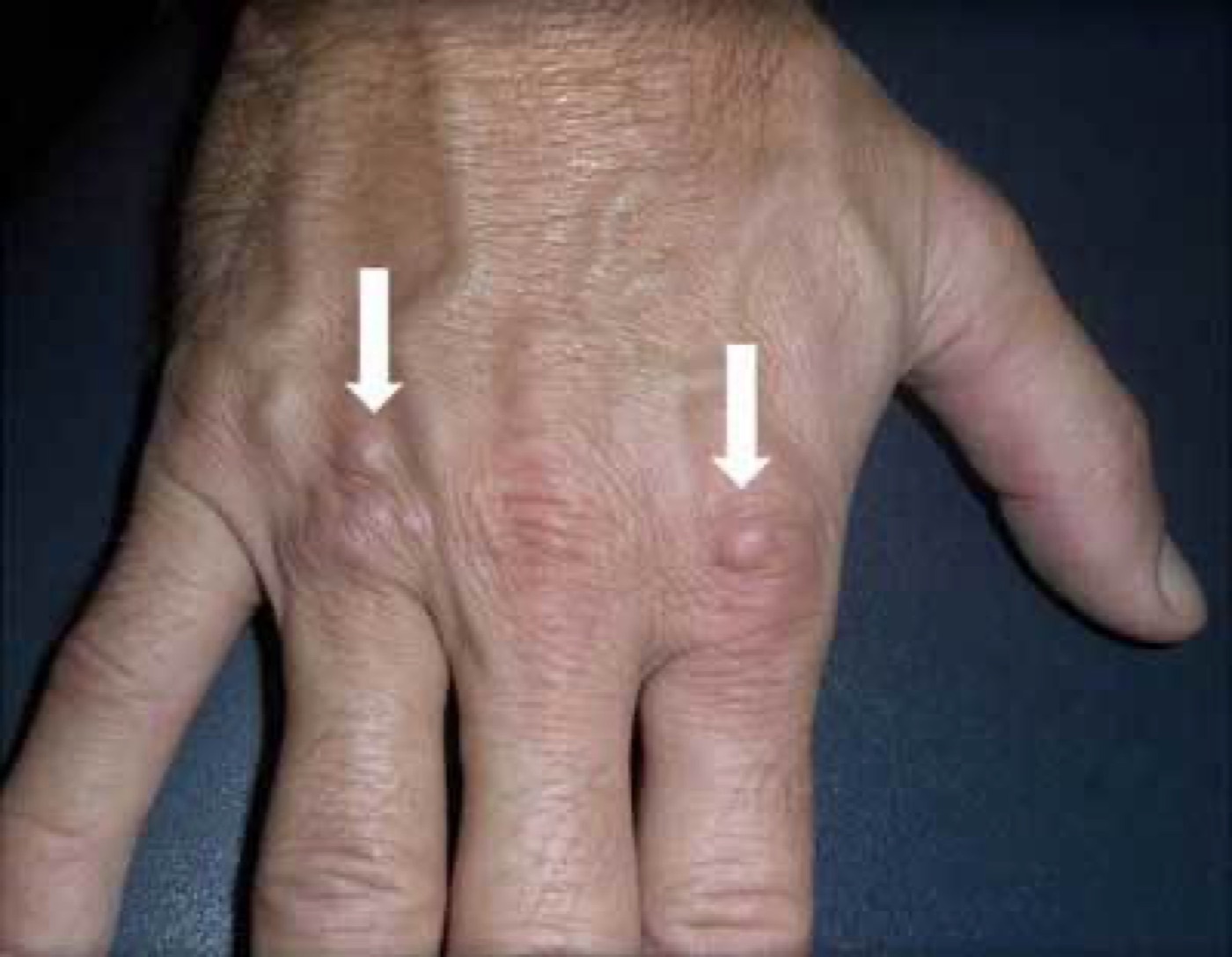 Figure 2. Garrod knuckle pads - dorsal nodules over the finger joints, an ectopic manifestation. From De Keersmaeker & Vanhoenacker (2016), J Belg Soc Radiol, PMC6102944, CC BY 4.0.