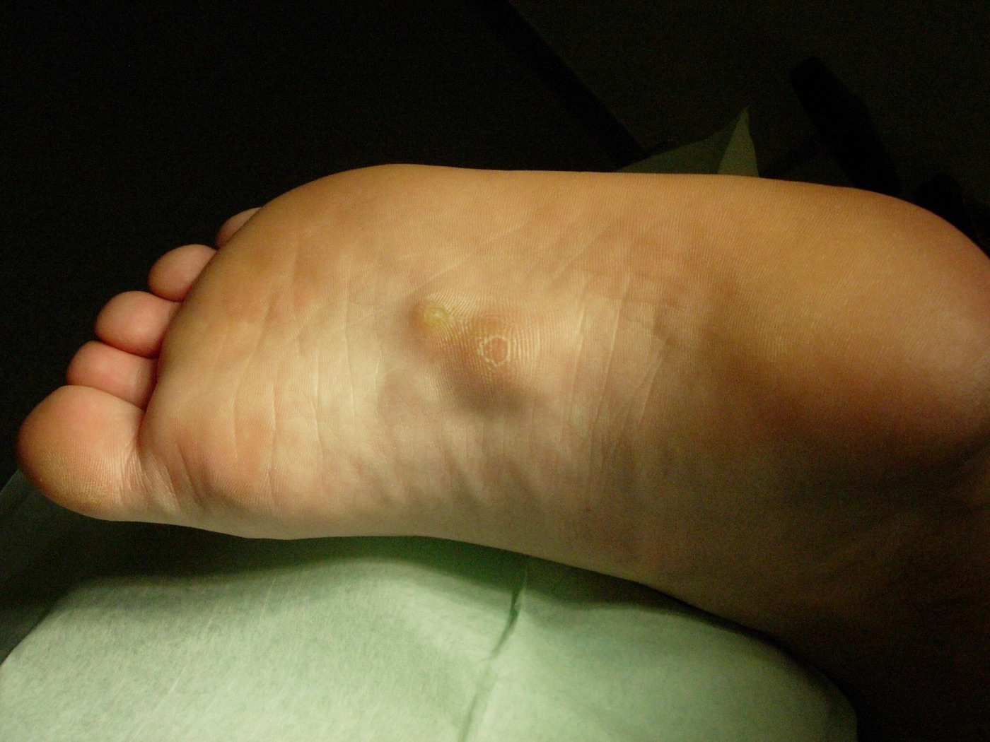 Figure 3. Ledderhose disease - plantar fibromatosis, the foot counterpart of Dupuytren. Source: Herecomesdoc, via Wikimedia Commons, CC BY-SA 3.0.