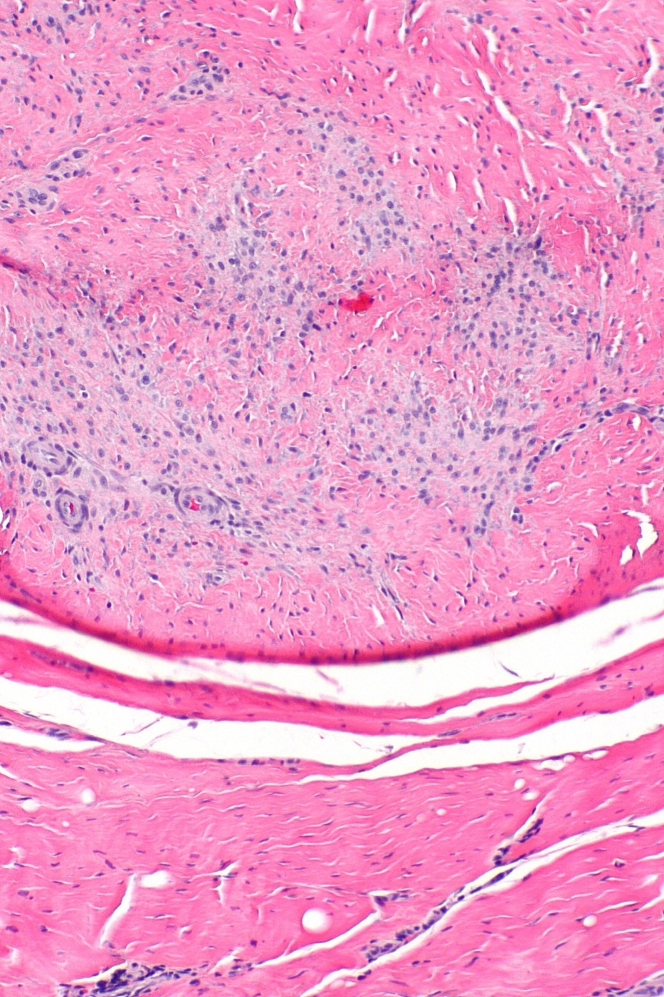 Figure 4. Histology of palmar fibromatosis (H\&E): a cellular nodule of spindle (myo)fibroblasts in collagen. Source: Nephron, via Wikimedia Commons, CC BY-SA 3.0.