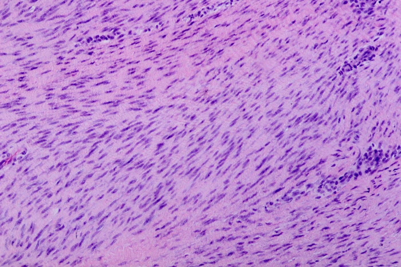 Figure 5. Proliferative-stage spindle-cell (fibroblast/myofibroblast) proliferation. Source: Patho, via Wikimedia Commons, CC BY-SA 3.0.
