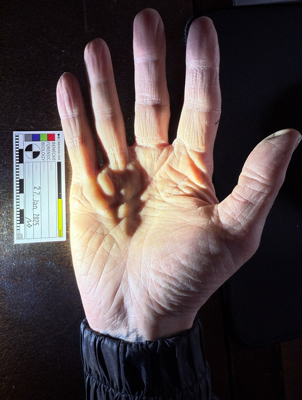 Figure 7. Palmar nodules and cords of Dupuytren disease (scale in cm). Source: Mark Benecke, via Wikimedia Commons, CC BY-SA 4.0.