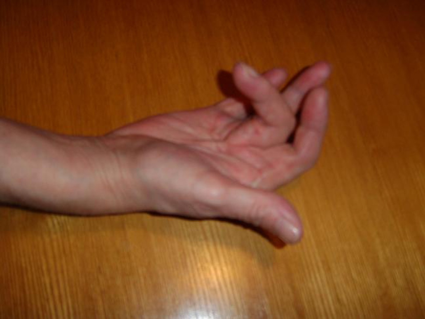 Figure 8. Established contracture: the hand cannot lie flat (a positive Hueston tabletop test). Source: Smartie77, via Wikimedia Commons, CC BY-SA 3.0.