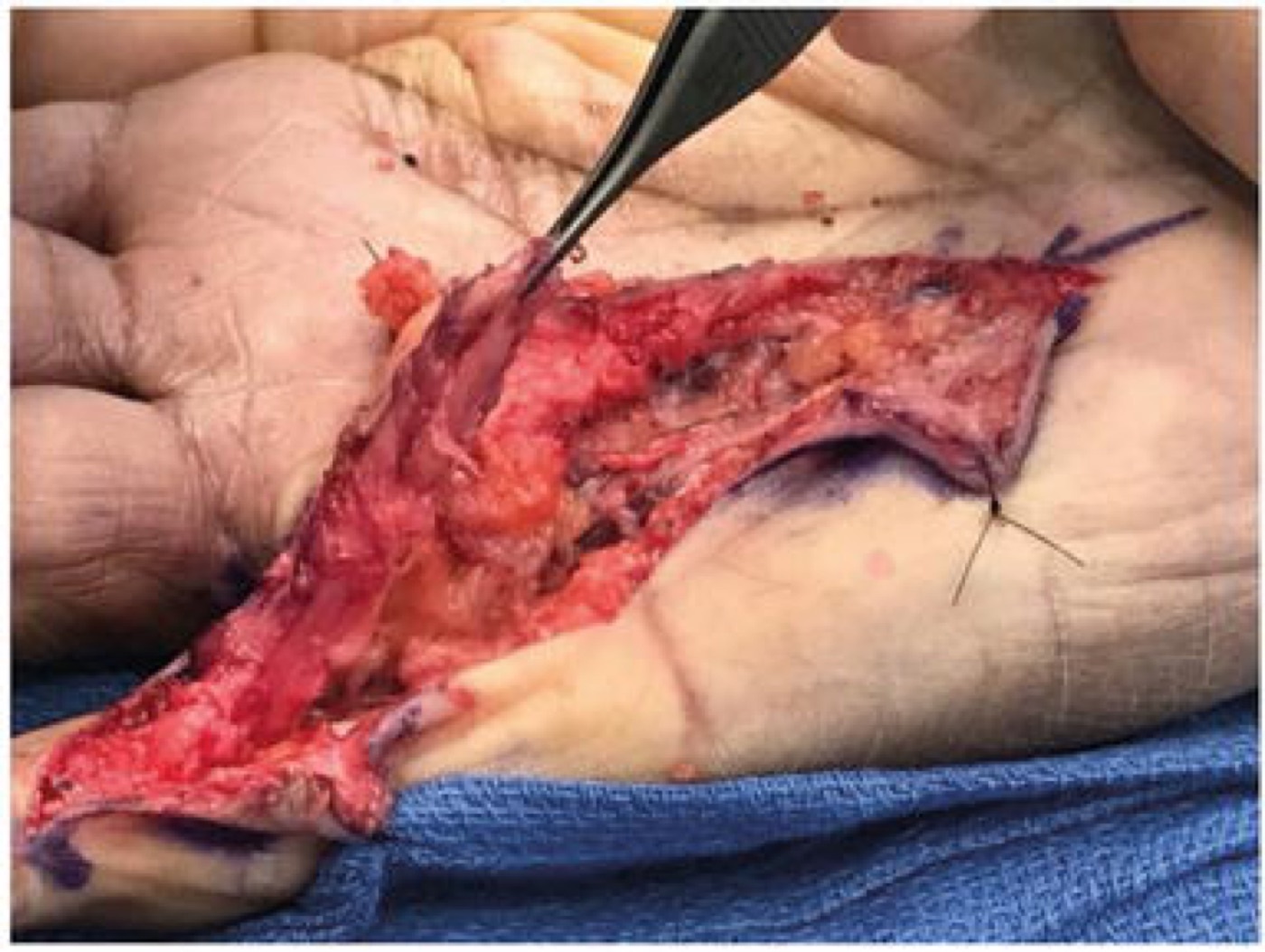Figure 11. Limited fasciectomy: the diseased cord elevated through a Brunner incision. From Johnson, Pavano & Rodner (2018), IntechOpen, CC BY 3.0.