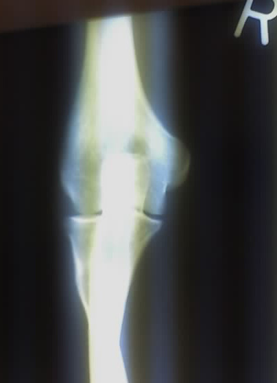 Figure 23. Normal anteroposterior radiograph of the right elbow (distal humerus, radial head and proximal ulna). Aspersions, CC BY-SA 2.5, via Wikimedia Commons.