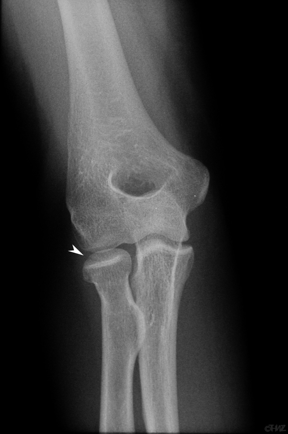 Figure 24. Anteroposterior radiograph of a minimally displaced radial head fracture (arrowhead), the typical indication for the posterolateral (Kocher) approach. Thomas Zimmermann, CC BY-SA 3.0 DE, via Wikimedia Commons.