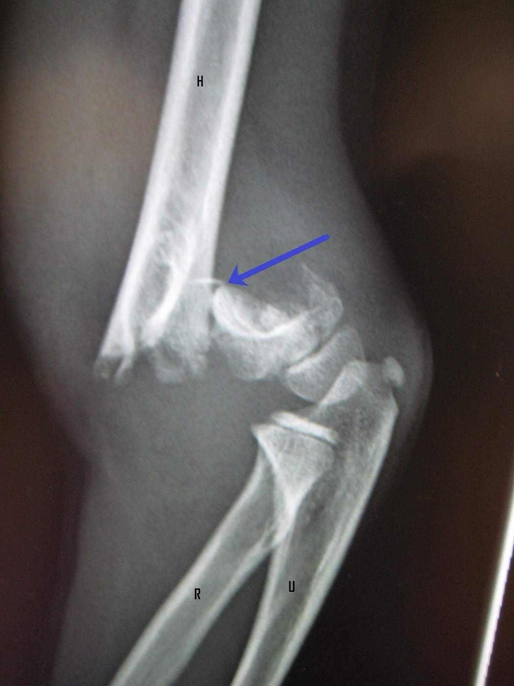 Figure 18. Paediatric supracondylar fracture of the humerus (arrow), the classic injury threatening the brachial artery and median nerve; H = humerus, R = radius, U = ulna. James Heilman MD, CC BY-SA 3.0, via Wikimedia Commons.