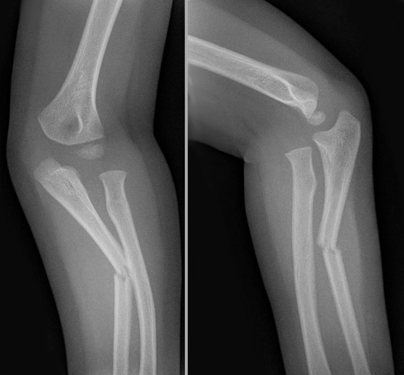 Figure 13. Monteggia fracture-dislocation: an ulnar fracture with dislocation of the radial head (AP and lateral). Source: Hellerhoff, via Wikimedia Commons, CC BY-SA 3.0.