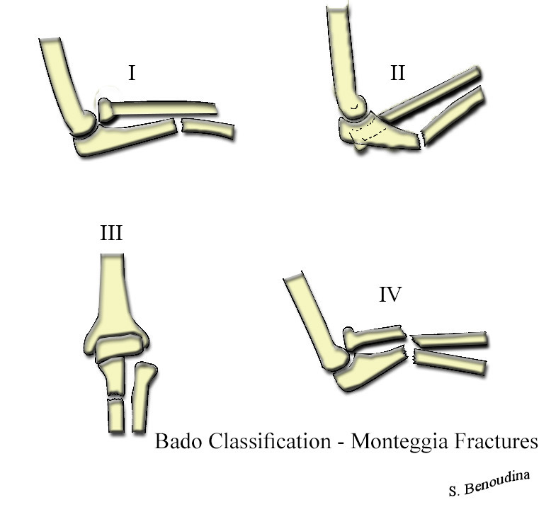 Figure 14. The Bado classification of Monteggia fracture-dislocations (types I to IV), by the direction of radial head displacement. Source: Benoudina Samir, via Wikimedia Commons, CC BY-SA 4.0.