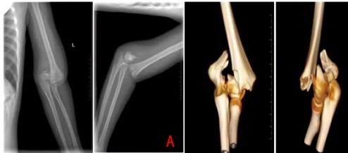 Figure 2. An intercondylar (bicolumnar, AO type-C) distal humerus fracture on radiograph and 3D CT. From Wang et al. (2026), Frontiers in Pediatrics, PMC13006493, CC BY 4.0.