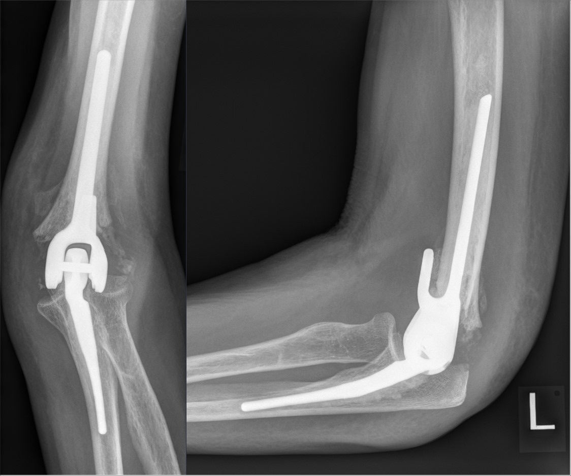 Figure 4. A cemented linked (semiconstrained) total elbow arthroplasty, the alternative to fixation for the unreconstructable fracture in the low-demand elderly. Source: Hellerhoff, via Wikimedia Commons, CC BY-SA 4.0.
