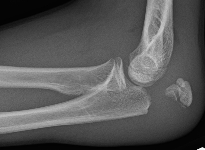 Figure 5. A displaced transverse olecranon fracture on the lateral radiograph: the triceps pulls the proximal fragment away, opening the articular surface. Source: James Heilman, MD, via Wikimedia Commons, CC BY-SA 4.0.