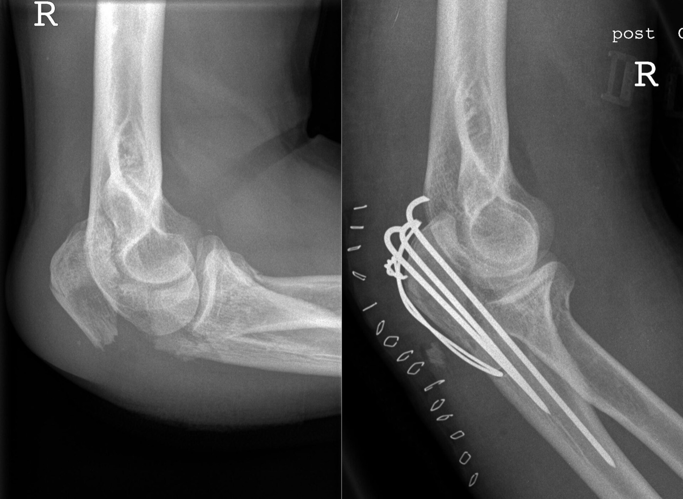 Figure 6. Tension-band (Weber) osteosynthesis: the displaced olecranon fracture (left) and the same elbow after fixation with two parallel K-wires and a figure-of-eight cerclage wire (right). Source: Michael Müller-Hillebrand, via Wikimedia Commons, CC BY 3.0.