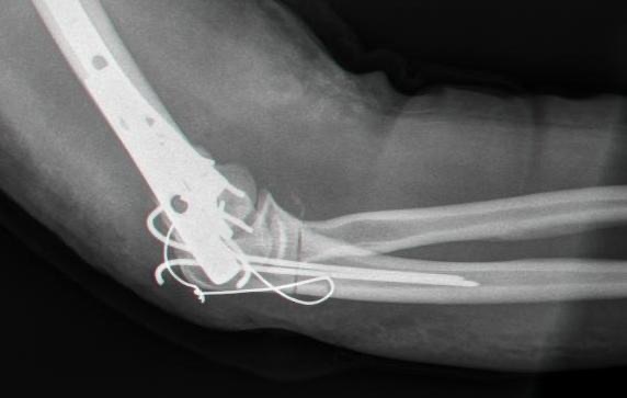 Figure 7. Plate-and-wire fixation of the olecranon, the construct chosen for comminuted, unstable, or fracture-dislocation patterns where a tension band cannot be used. Source: Mehlauge, public domain, via Wikimedia Commons.
