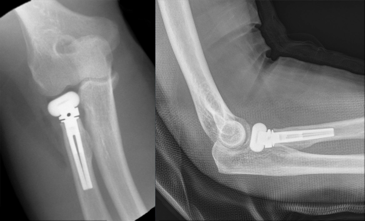 Figure 9. Metallic radial-head arthroplasty after a comminuted (unreconstructable) fracture. Source: Hellerhoff, via Wikimedia Commons, CC BY-SA 4.0.