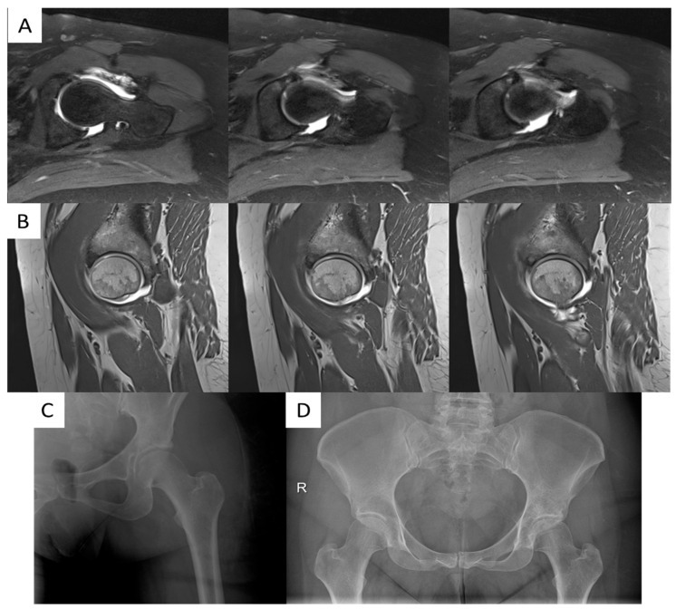 MR arthrogram of an acetabular labral tear. Axial T2 (A) and sagittal T1 (B) MR-arthrogram images show an antero-superior labral tear with subchondral cystic change. Minelli et al., J Clin Med 2025;14:8298, Fig. 5 (CC BY 4.0).