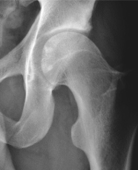 Cam morphology. AP hip showing loss of the normal head-neck offset with a focal convexity at the anterosuperior junction (the “pistol-grip” appearance). From Ruiz Santiago et al., Radiol Res Pract 2016;2016:6369237, Fig. 1d (CC BY 4.0).