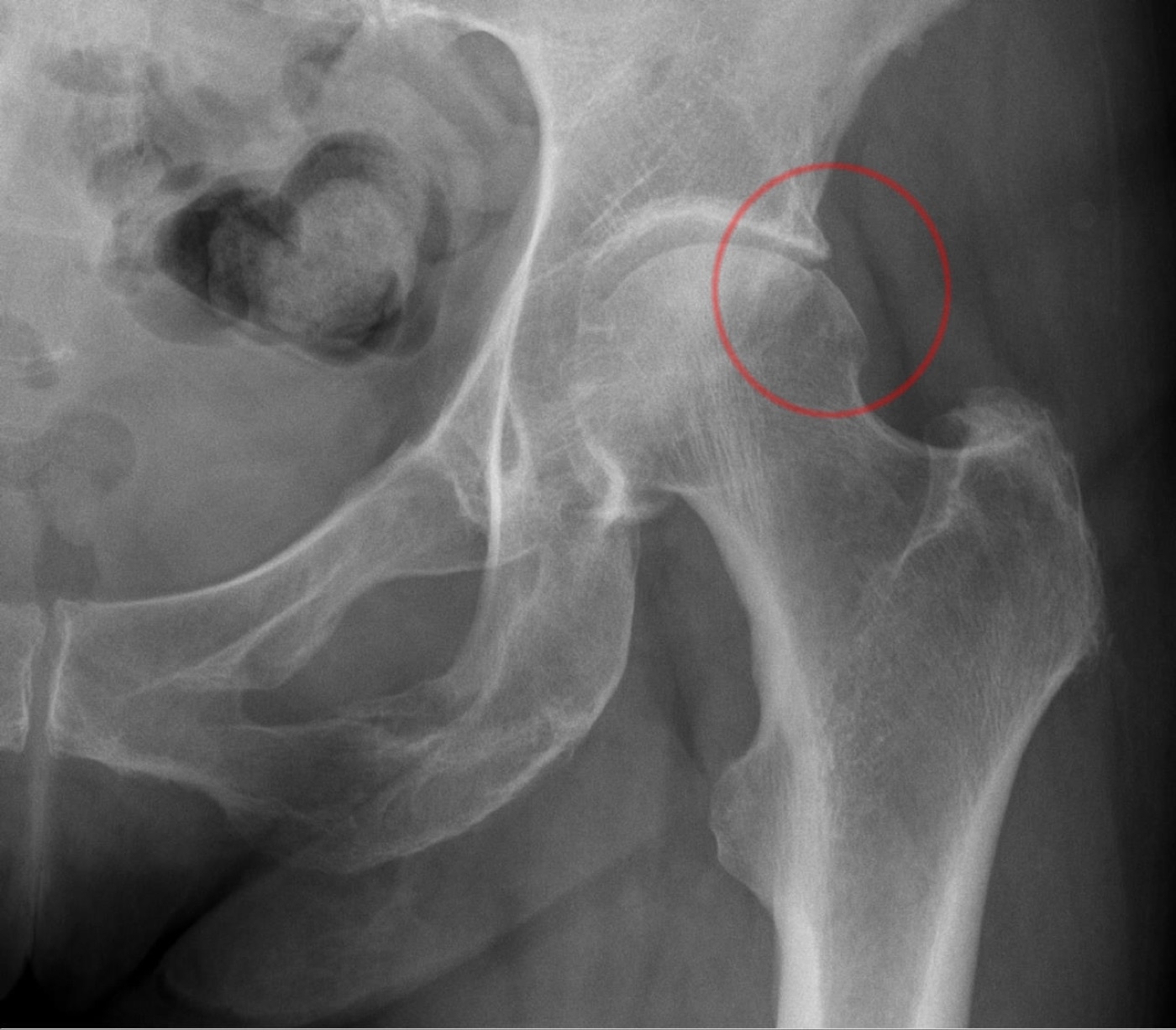 Combined-type FAI. Single-hip AP radiograph; the circle marks a focal bony prominence at the antero-superior head-neck junction (a dominant cam with a minor pincer component). Hellerhoff, Wikimedia Commons, CC BY-SA 3.0.