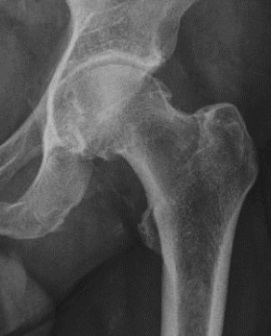 Pincer morphology. AP hip showing acetabular over-coverage of the femoral head. From Ruiz Santiago et al., Radiol Res Pract 2016;2016:6369237, Fig. 1c (CC BY 4.0).