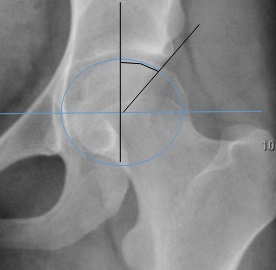 Lateral centre-edge angle of Wiberg. Construction on an AP hip: the angle between the vertical through the head centre and the line to the lateral acetabular edge. From Ruiz Santiago et al., Radiol Res Pract 2016;2016:6369237, Fig. 6b (CC BY 4.0).