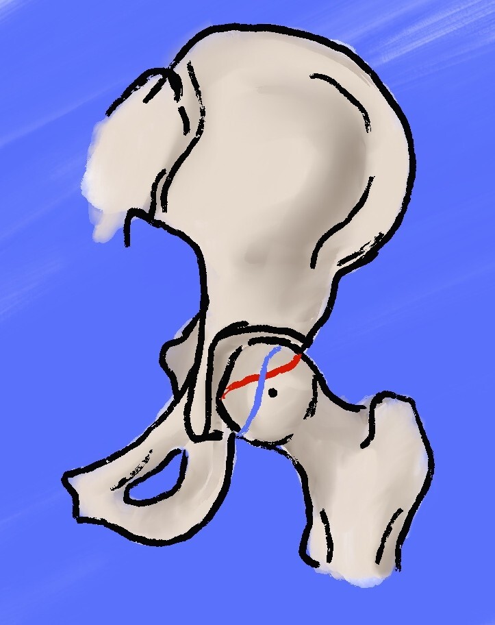 Crossover sign of acetabular retroversion (schematic). The anterior acetabular wall (red) crosses lateral to the posterior wall (blue) in the cranial acetabulum. Beckenrandgeschichten, Wikimedia Commons, CC BY-SA 4.0.