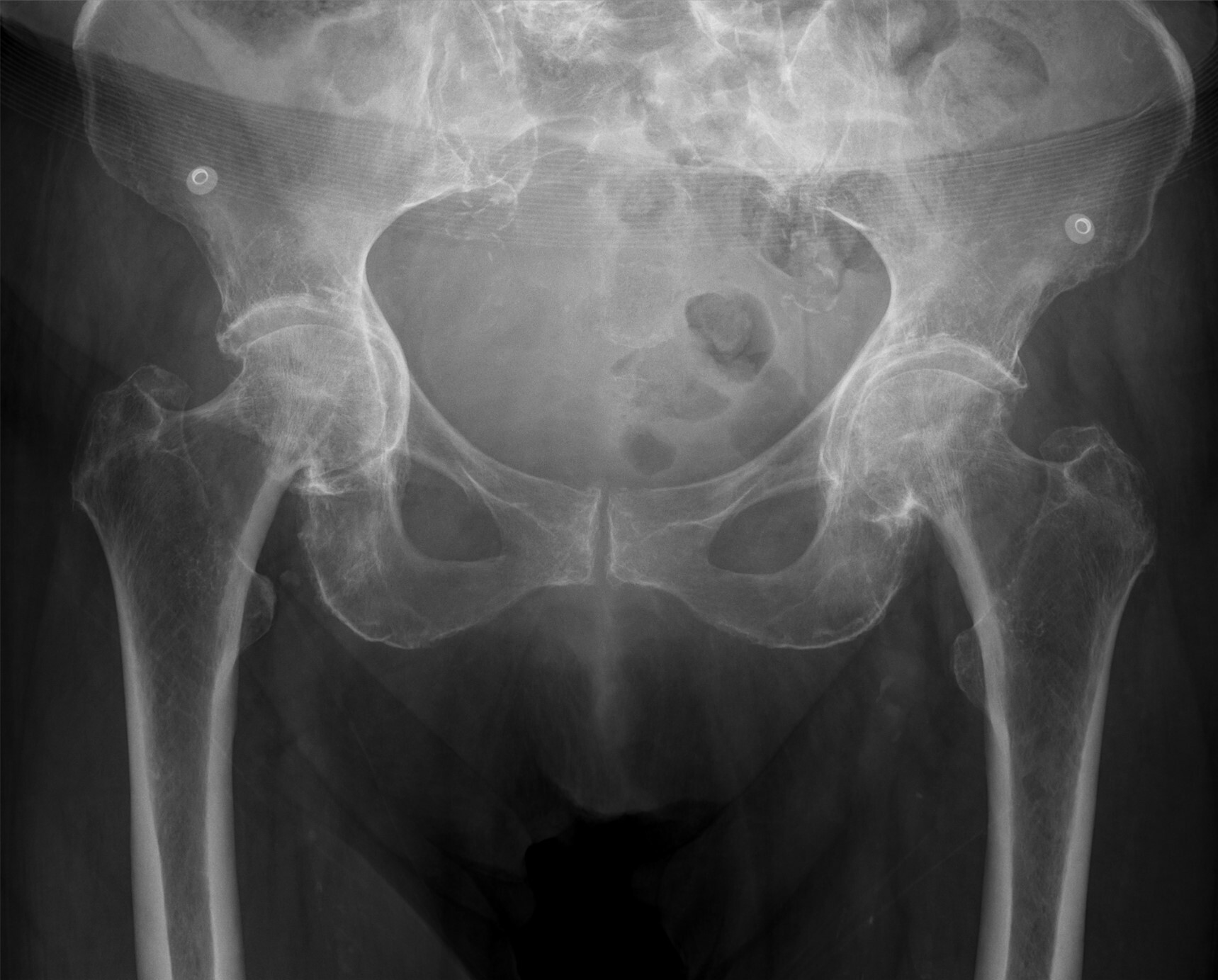 Coxa profunda and protrusio acetabuli. AP pelvis with coxa profunda on the left and protrusio acetabuli (head medial to the ilioischial line) on the right - the over-coverage end of the pincer spectrum. Hellerhoff, Wikimedia Commons, CC BY-SA 4.0.