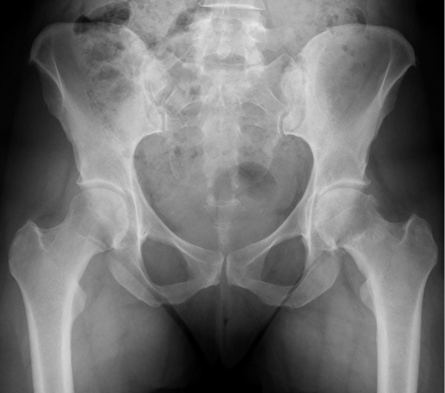 Cam impingement with secondary osteoarthritis. AP pelvis: a prominent head-neck convexity (cam) with central joint-space narrowing - the cam deformity having progressed to coxarthrosis. Hellerhoff, Wikimedia Commons, CC BY-SA 4.0.