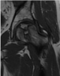 Figure 12. Avascular necrosis of the femoral head on T1-weighted MRI. Ruiz Santiago et al., CC BY 4.0, via Wikimedia Commons.