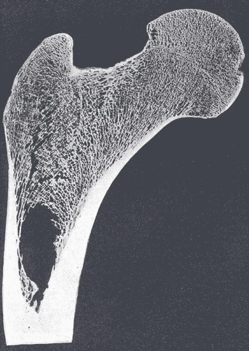 Figure 2. Frontal section of the proximal femur showing the head, neck, and the calcar femorale with its trabecular architecture. Henry Vandyke Carter, Gray’s Anatomy, public domain, via Wikimedia Commons.