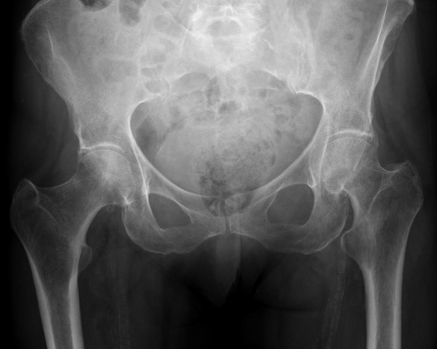 Figure 3. A displaced subcapital (medial) femoral neck fracture on AP radiograph. Hellerhoff, CC BY-SA 4.0, via Wikimedia Commons.
