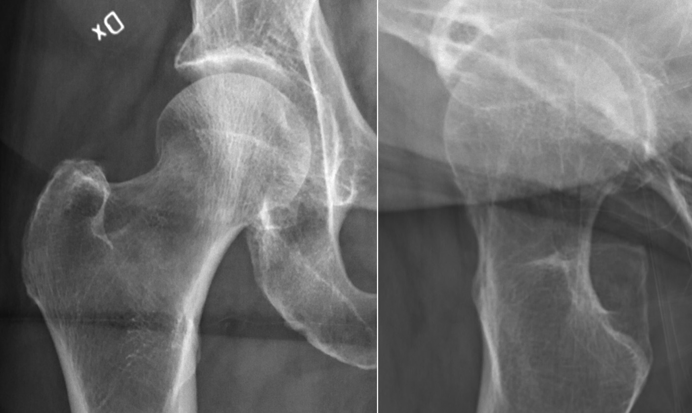 Figure 6. A subtle valgus-impacted femoral neck fracture (Garden I), with a sclerotic impaction line across the neck. Mikael Häggström, CC0, via Wikimedia Commons.