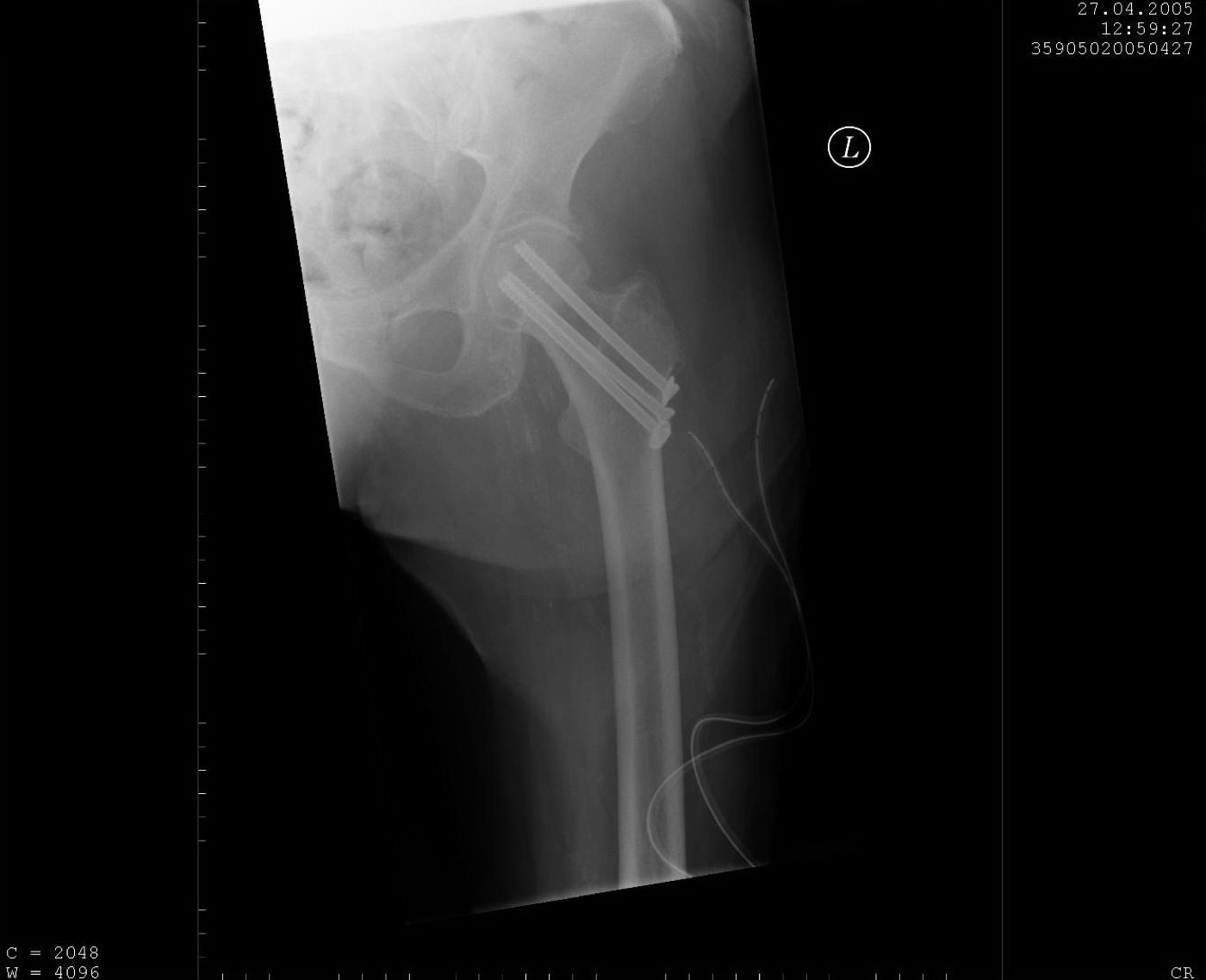 Figure 7. A femoral neck fracture fixed with cannulated screws. Sjoehest, CC BY-SA 3.0, via Wikimedia Commons.