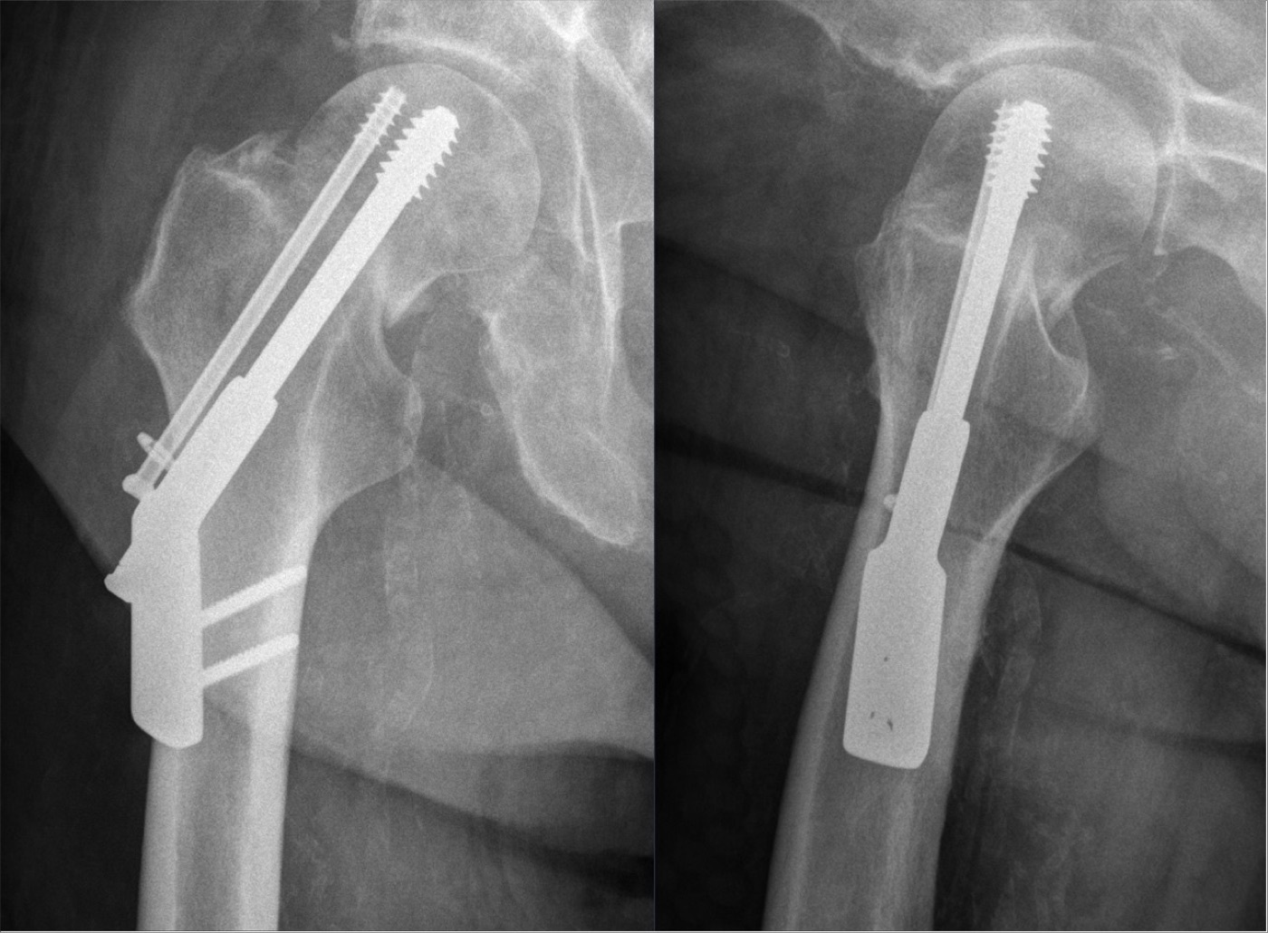 Figure 8. A dynamic (sliding) hip screw with an antirotation screw, two projections. Hellerhoff, CC BY-SA 4.0, via Wikimedia Commons.